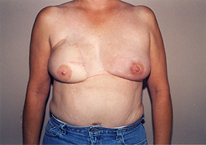 Breast Reconstruction 2b